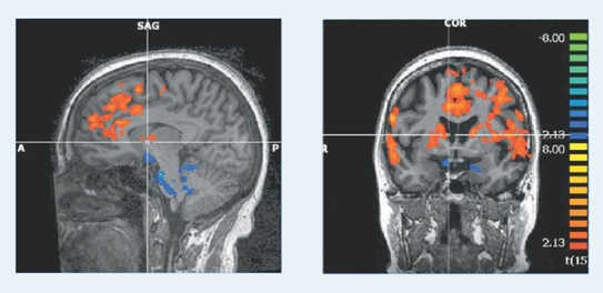 Transcendental Meditation: Deactivation of the Amygdala, Reactivation of the Pre-Frontal Cortex