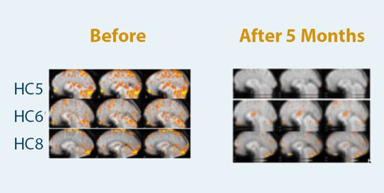 Reduction in Brain Response to Pain